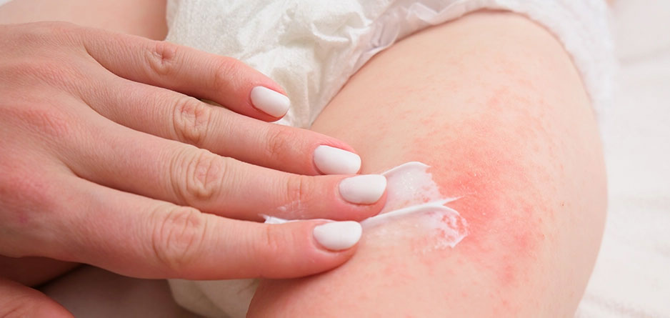 سودوکرم ضد التهاب و ترمیم‌کننده پوست نوزاد، مناسب پیشگیری از سوختگی پوشک