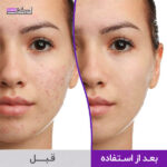 ژل ضدجوش و لایه بردار DIFFERIN دیفرین مدل ADAPALENE 0.1%