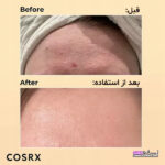 تصویر مقایسه قبل و بعد استفاده از سرم اسنس حلزون کوزارکس Advanced Snail 96 و بهبود آبرسانی، شفافیت و کاهش آثار جای جوش