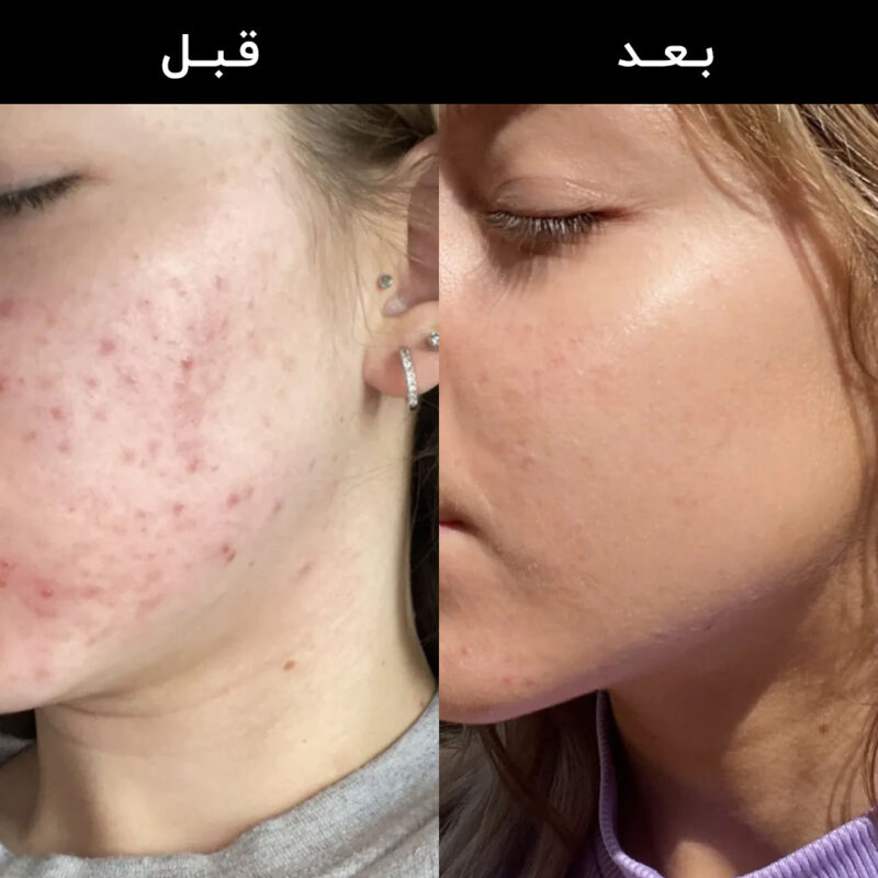 سرم نیاسینامید