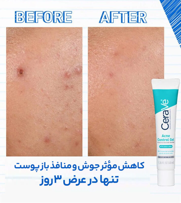 قیمت ژل ضد جوش سراوی
