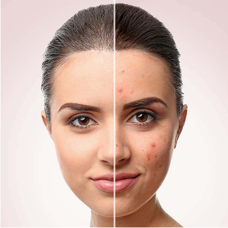 درمان جوش صورت با سالیسیلیک اسید