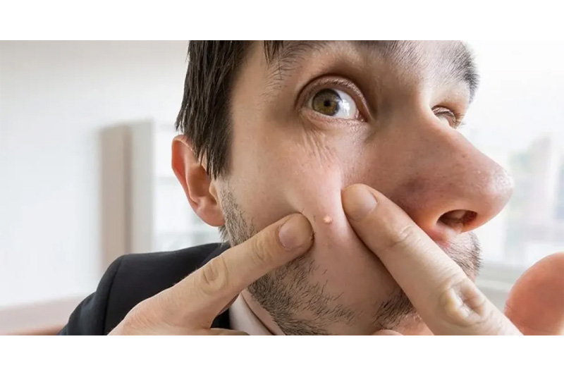 ترکاندن جوش کار درستی است؟