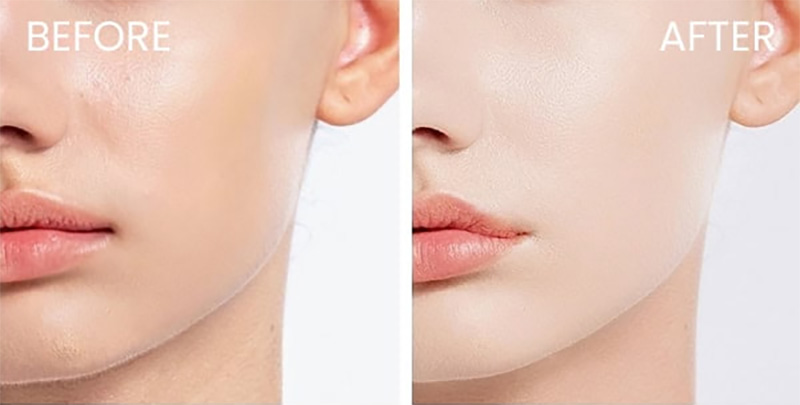 تأثیر آمپول منافذ سنتلا روی منافذ